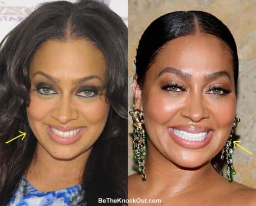 Lala Anthony Plastic Surgery Comparison Photos