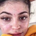 Kylie Jenner freckles and scars