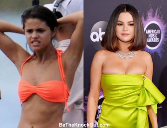 Selena Gomez Plastic Surgery Comparison Photos