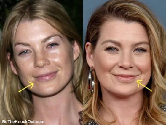 Ellen Pompeo Plastic Surgery Comparison Photos