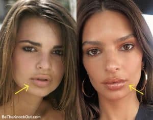 Emily Ratajkowski Plastic Surgery Comparison Photos