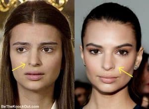 Emily Ratajkowski Plastic Surgery Comparison Photos