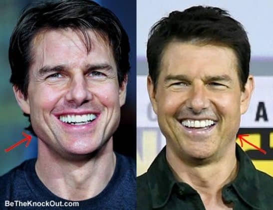 Tom Cruise Plastic Surgery Comparison Photos