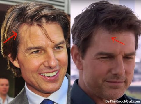 Tom Cruise Plastic Surgery Comparison Photos