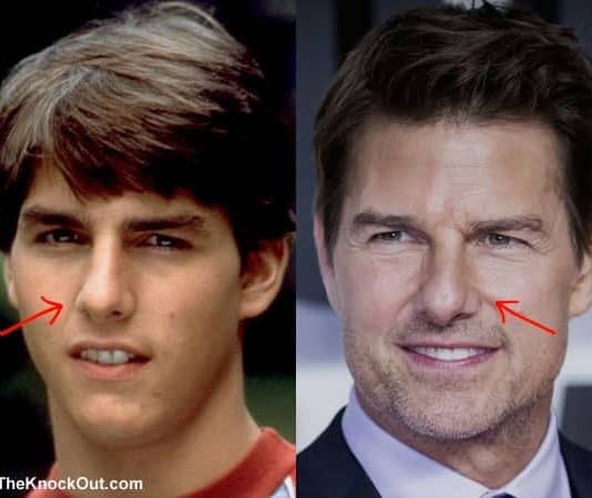 Did Tom Cruise ever had a nose job?