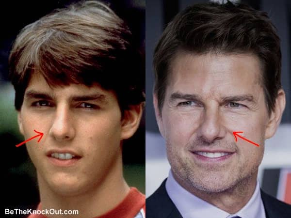 Did Tom Cruise ever had a nose job?