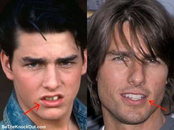 Tom Cruise Plastic Surgery Comparison Photos