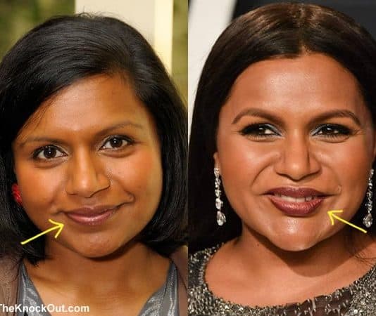 Has Mindy Kaling has lip injections?