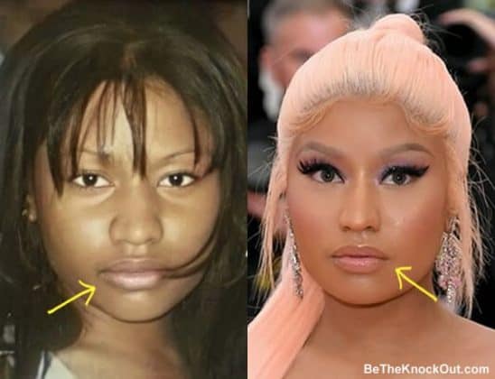 Nicki Minaj Plastic Surgery Comparison Photos