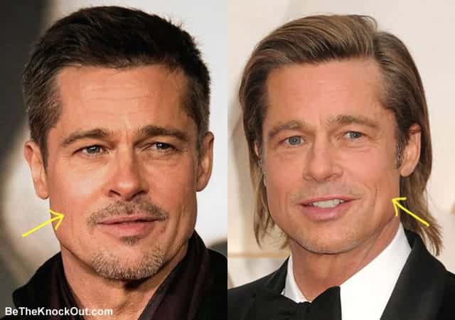 Brad Pitt Plastic Surgery Comparison Photos