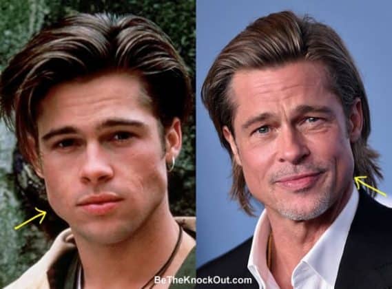 Brad Pitt Plastic Surgery Comparison Photos