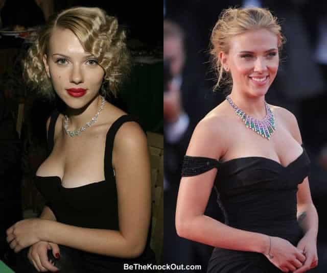 Did Scarlett Johansson have a boob job?