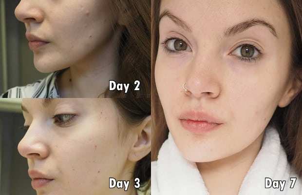 Strawberry cleanser 1 week result