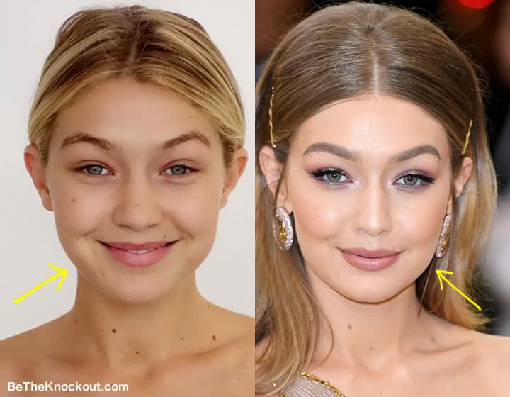 Gigi Hadid botox before and after comparison photo