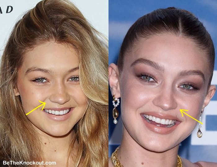 Gigi Hadid nose job before and after comparison photo