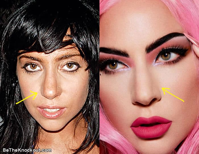 Lady Gaga Plastic Surgery Comparison Photos 