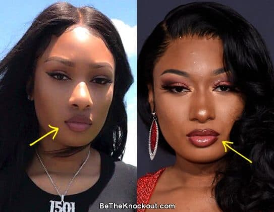 Megan Thee Stallion Before Plastic Surgery