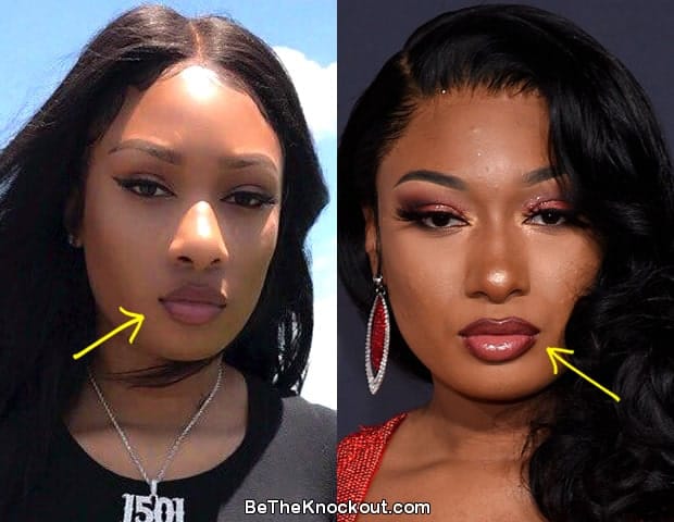 Megan Thee Stallion Plastic Surgery Comparison Photos