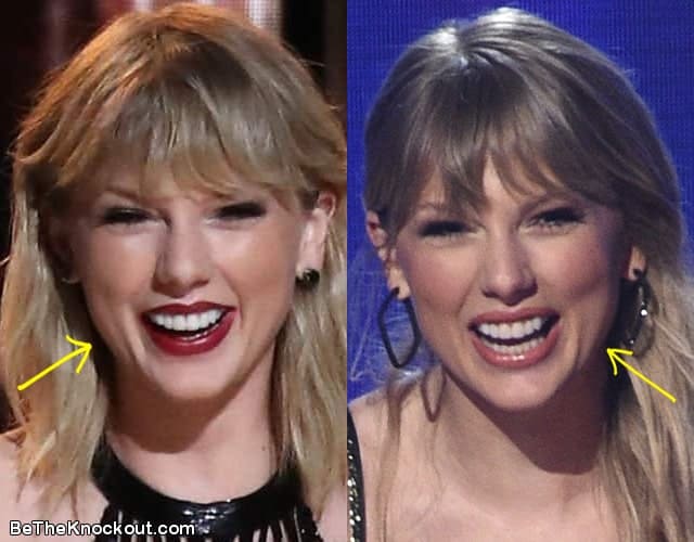 Taylor Swift Plastic Surgery Comparison Photos