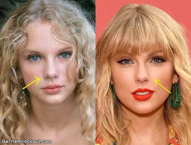 Taylor Swift Plastic Surgery Comparison Photos