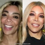 Wendy Williams botox before and after comparison photo