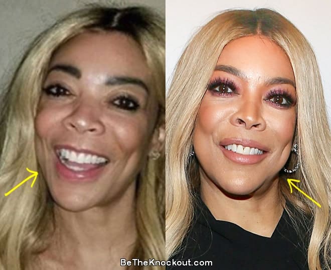 Wendy Williams botox before and after comparison photo