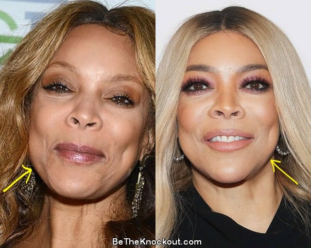 Wendy Williams Plastic Surgery Comparison Photos   Wendy Williams Facelift 