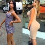 Anastasia Kvitko butt lift before and after photo comparison