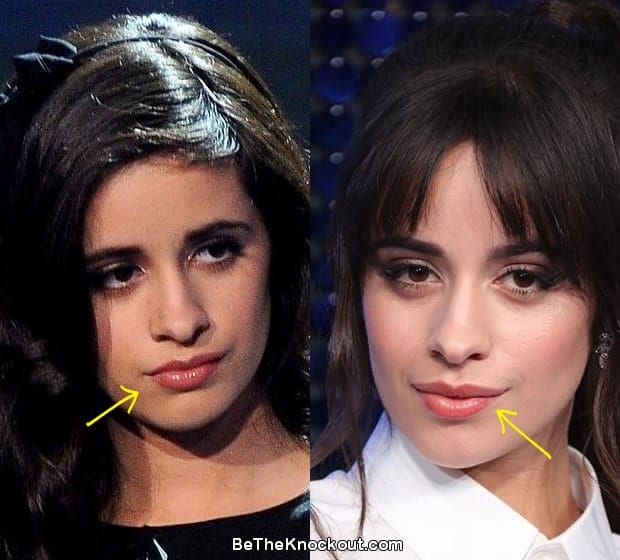 Camila Cabello Plastic Surgery Comparison Photos
