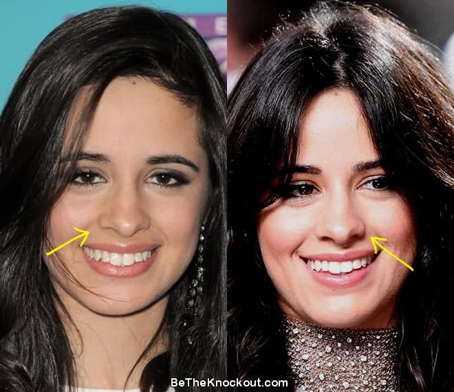 Camila Cabello Plastic Surgery Comparison Photos