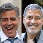George Clooney botox before and after photo comparison