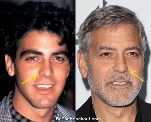 George Clooney Plastic Surgery Comparison Photos