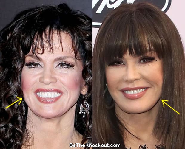 Marie Osmond Plastic Surgery Comparison Photos