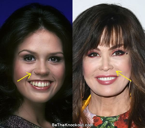 Marie Osmond Plastic Surgery Comparison Photos