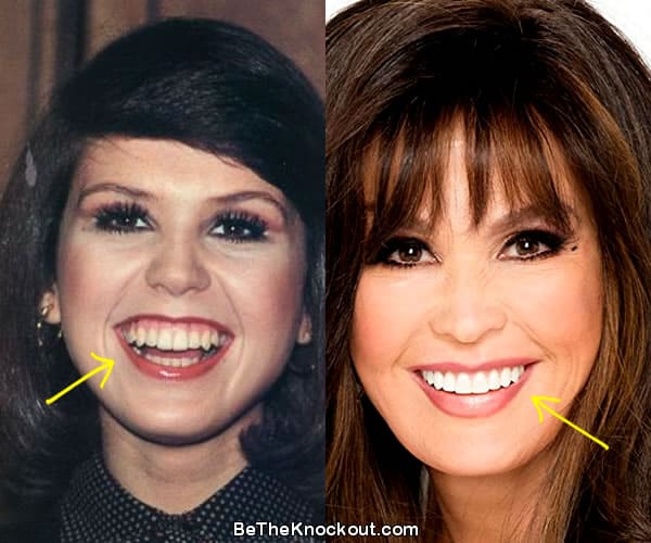 Marie Osmond Plastic Surgery Comparison Photos