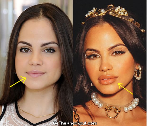 Natti Natasha lip injections before and after photo comparison