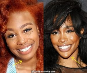 SZA Plastic Surgery Comparison Photos