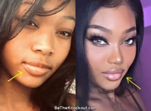 Summer Walker Plastic Surgery Comparison Photos