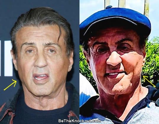Sylvester Stallone Plastic Surgery Comparison Photos