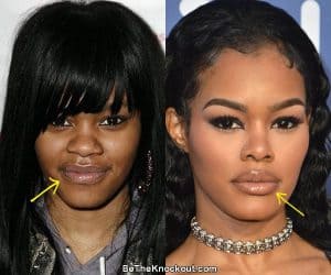 Teyana Taylor Plastic Surgery Comparison Photos