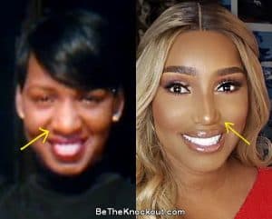 Nene Leakes Plastic Surgery Comparison Photos