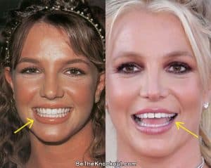 Britney Spears Plastic Surgery Comparison Photos