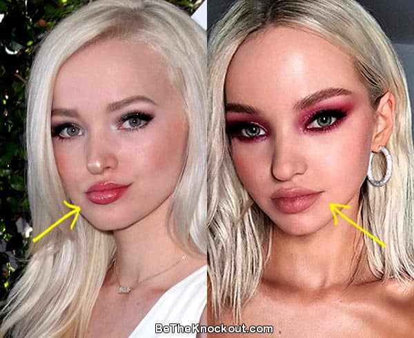 Dove Cameron Plastic Surgery Comparison Photos