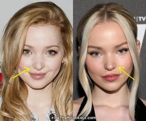 Dove Cameron Plastic Surgery Comparison Photos