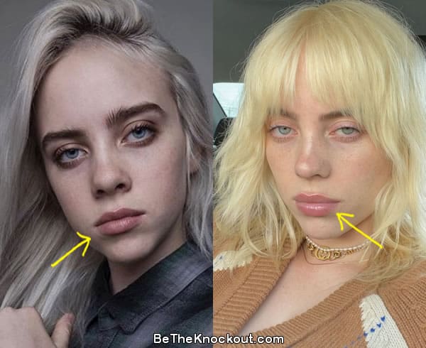 Does Billie Eilish Have Lip Fillers