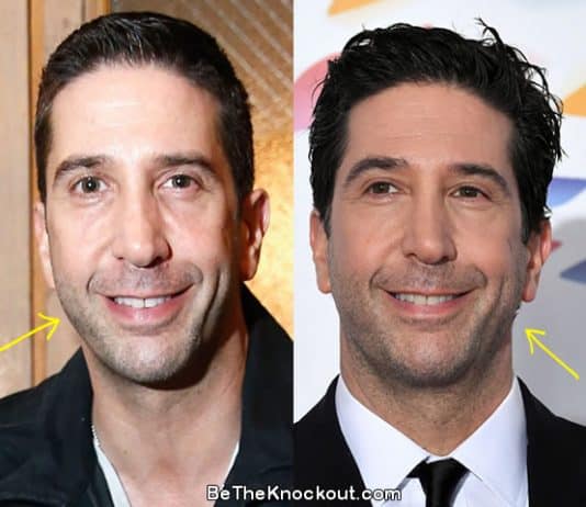 David Schwimmer botox before and after comparison photo
