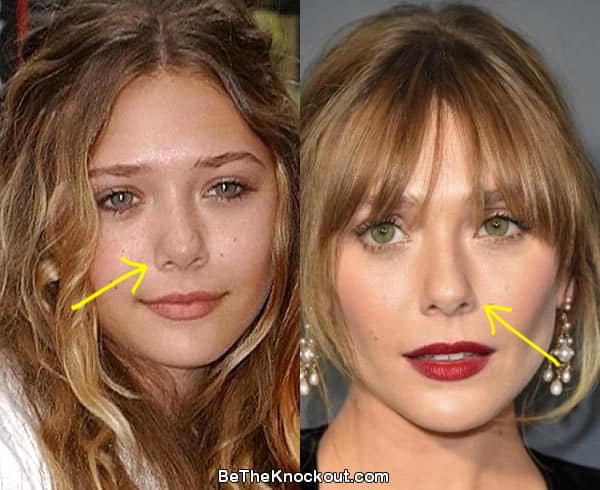 Elizabeth Olsen nose job before and after comparison photo