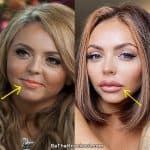 Jesy Nelson lip injections before and after comparison photo