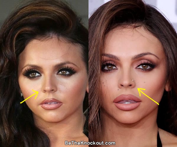 Jesy Nelson nose job before and after comparison photo