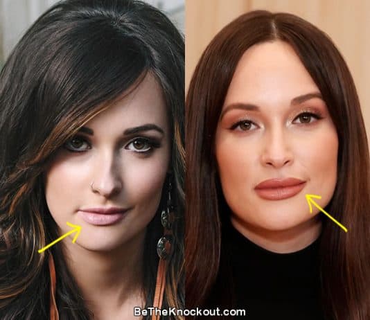 Kacey Musgraves lip fillers before and after comparison photo